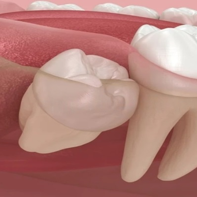 wisdom tooth